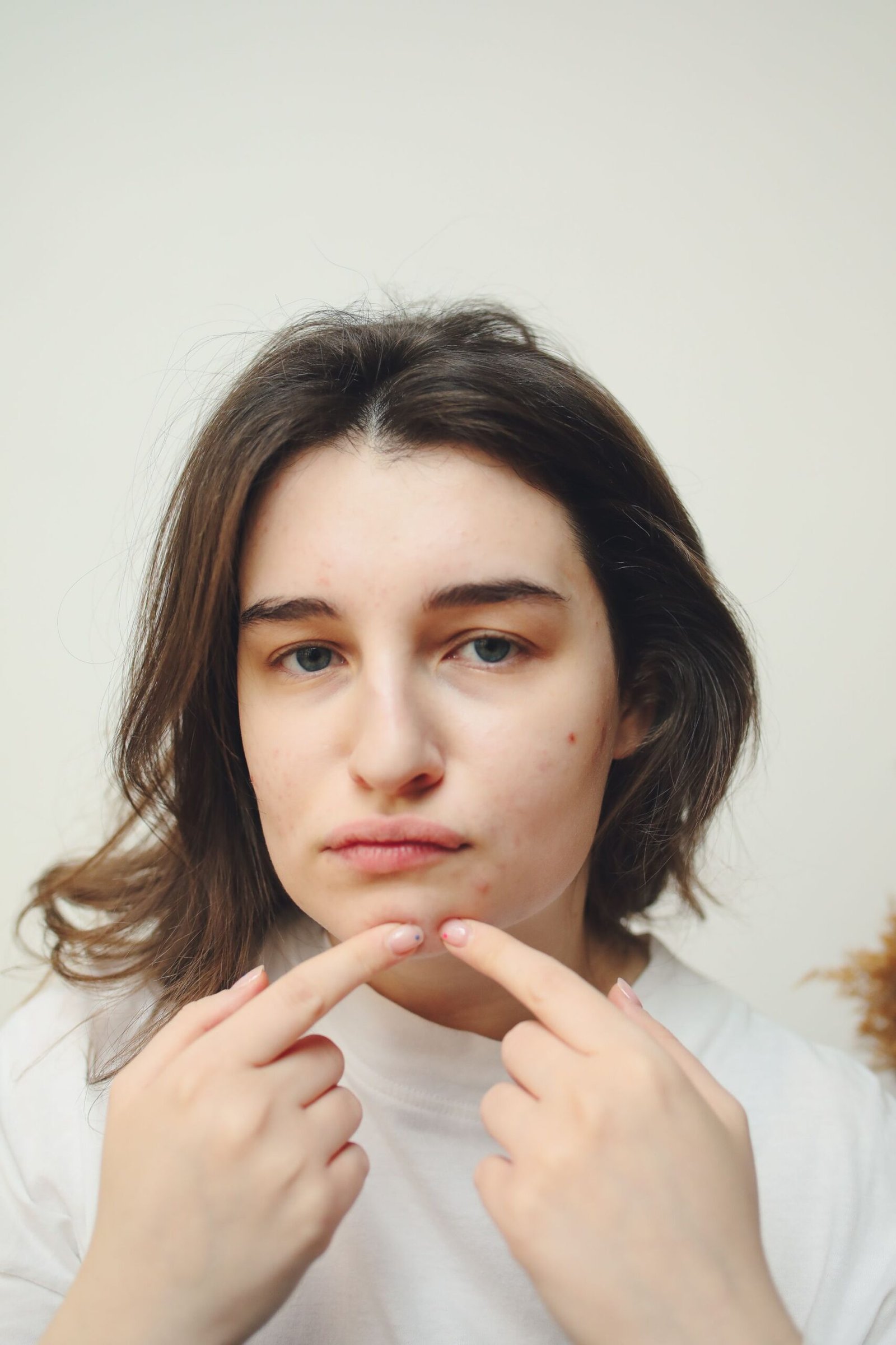 how to reduce inflammation on a pimple